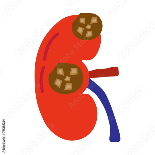 chronic kidney stone disease