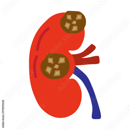 chronic kidney stone disease