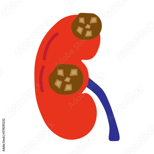 chronic kidney stone disease