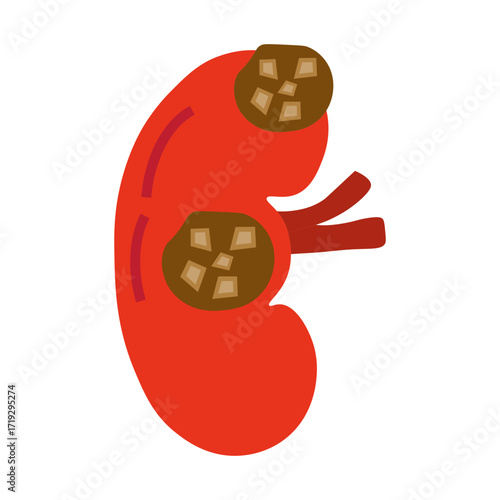 chronic kidney stone disease