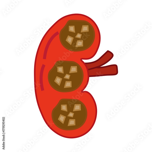 chronic kidney stone disease