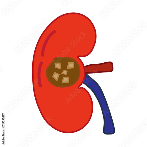 chronic kidney stone disease