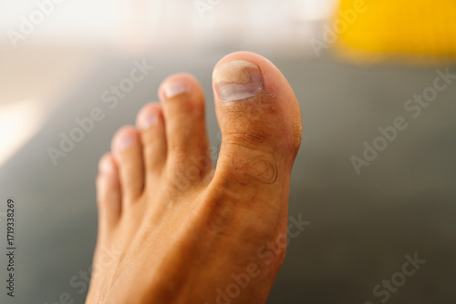 A close-up of a man's foot with an injured big toe. The toe shows a bruise and discolored nail. Health concept, nail plate problem, skin care.