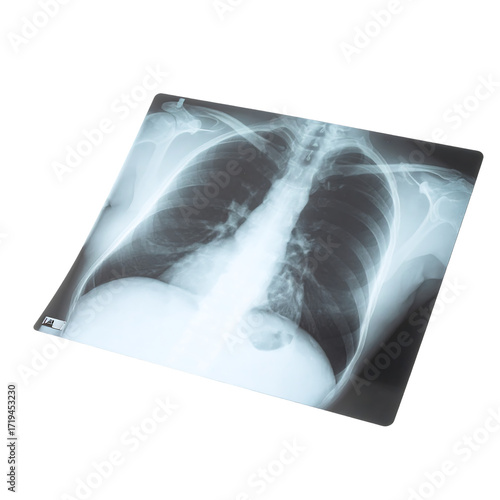 A grayscale chest X-ray, slightly angled, shows lungs, ribs, and spine; subtle shadowing is visible