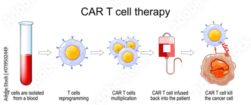 CAR T cell therapy. Cancer immunotherapy. CAR-T-cell therapy for killing of tumor cells