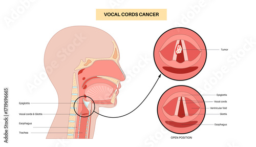 Vocal cord cancer medical poster