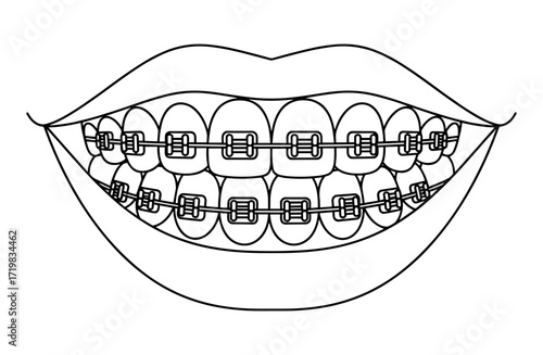 Braces close-up line drawing in black and white