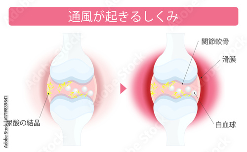 膝関節痛
