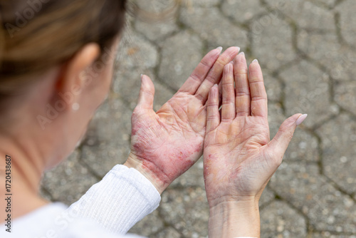 Skin conditions like eczema and psoriasis cause visible discomfort on hands in an outdoor setting during daylight