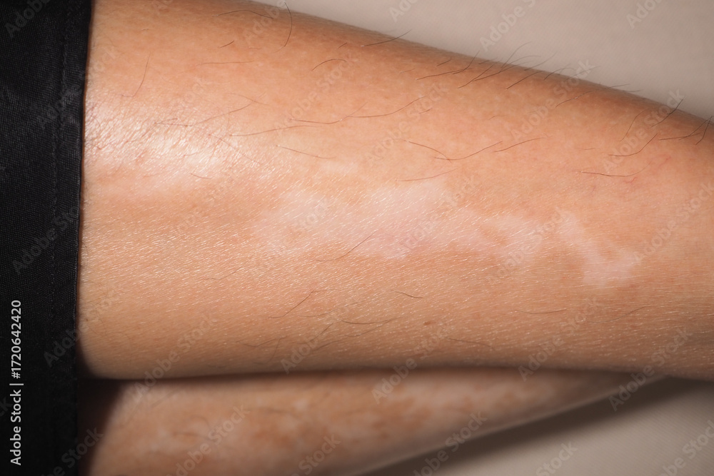 Fototapeta premium Skin condition showing light patches on the arm in detail