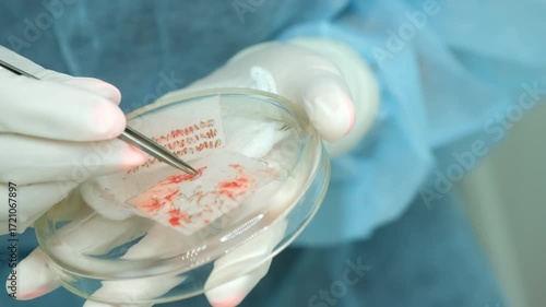 Surgeon nurse hands putting changing hair grafts using tweezers preparing it to hair transplantation in clinic. Problem of baldness, treatment of alopecia by hair transplant surgery in hospital.