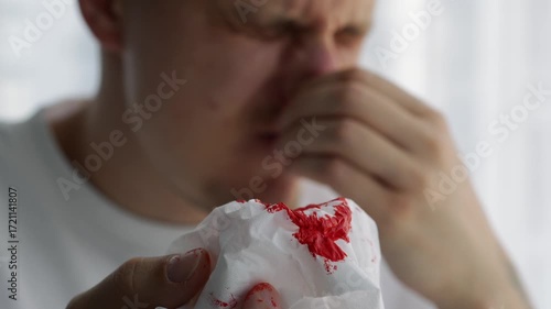A nosebleed due to burst blood vessels.
An allergy sufferer will wipe the blood from his nose.
A nasal injury and cartilage fracture.
A man was punched in the nose and is now bleeding.