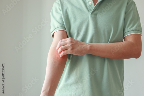 Young asian man itching and scratching on arm from allergic itchy dry skin eczema dermatitis insect bites