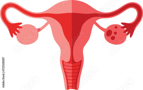 Anatomical illustration showing female reproductive organs, highlighting polycystic ovary syndrome with cysts on one ovary