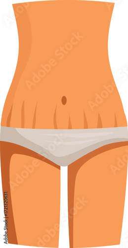 Female body with stretch marks wearing underwear, depicting postpartum or weight loss recovery