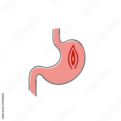 Illustration of stomach with ulcer, medical symbol for disease.