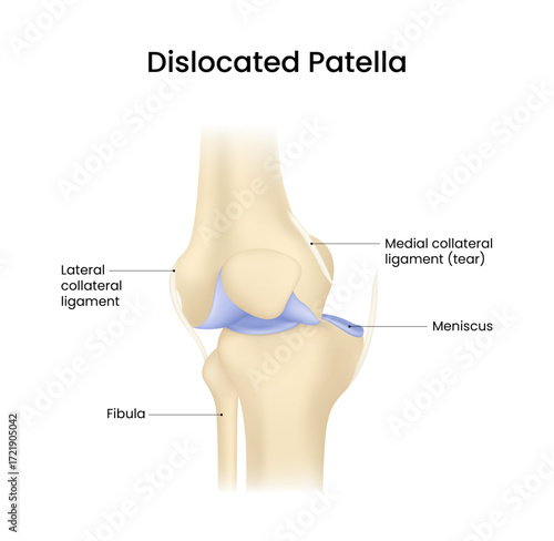 Dislocated Patella Anatomy of Knee Injury