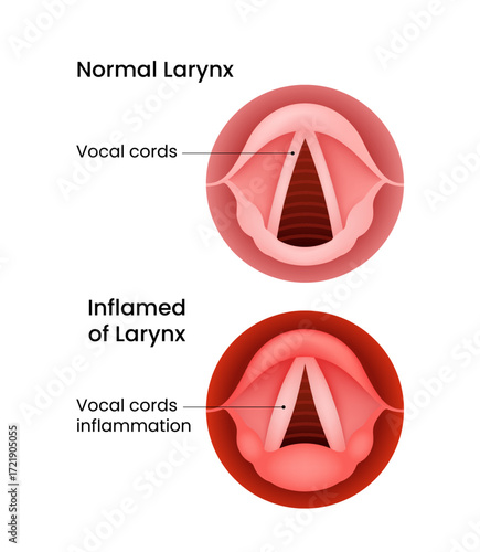 Normal and Inflamed Larynx Comparison