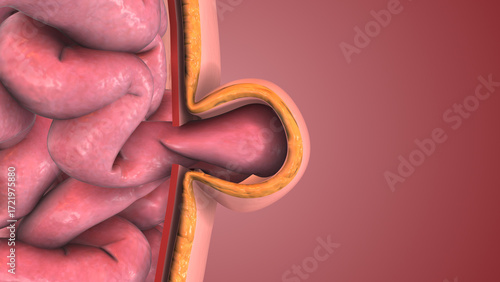 3D Medical Concept of Abdominal Hernia Development