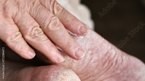 Woman applies moisturizing cream to her dry cracked heel. Roughened skin on the foot.  Dry heels on problem skin, lack of pedicure and care and  fungal infections.