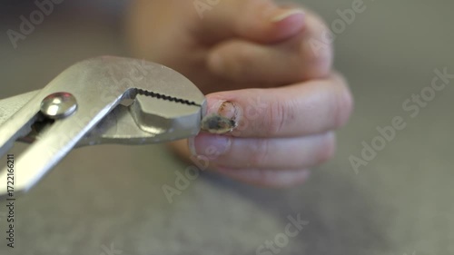 This video shows a close up view of an old, broken, and rotten finger nail being peeled over with pliers.