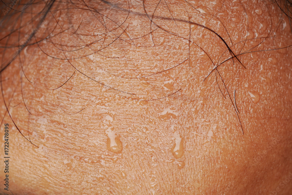 Fototapeta premium Skin shows droplets of sweat on forehead in warm weather conditions