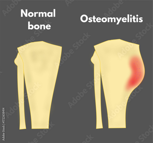 normal bone versus osteomyelitis bone infected bone comparison difference useful orthopedic ortho medical illustration.eps