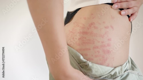 Woman Open Her Pants And Shows Her Thighs With Red Stretch Marks. - closeup shot