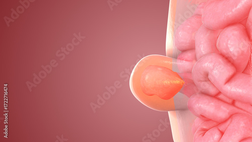 Medical Visualization of Human Abdominal Hernia Formation