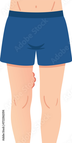 An illustration of a person exhibiting painful swelling in the groin area, representing lymph node infection or lymphadenitis