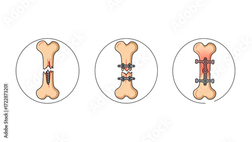 Advanced Bone Fracture Healing Process with Surgical Fixation and Recovery Stages - Comprehensive Orthopedic Illustration