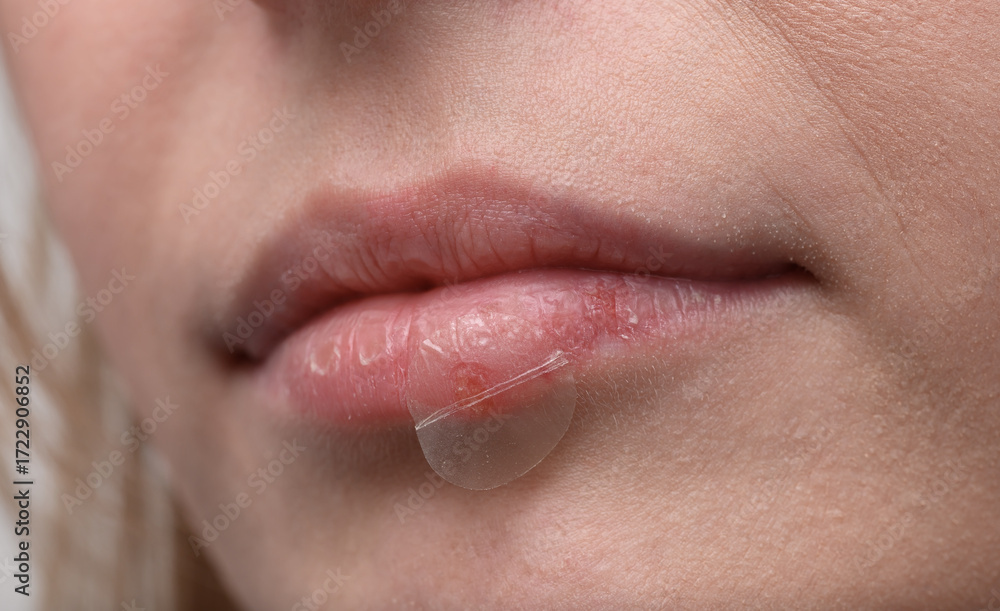 Obraz premium Cold sore patch, red pimple on woman's lips close up