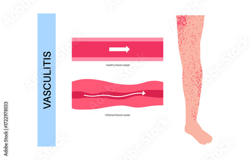 Vasculitis medical poster