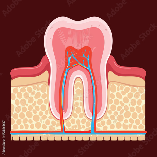 Detailed cross-section illustration of a diseased tooth with decay reaching the pulp, showing the root canal and surrounding bone and tissue	