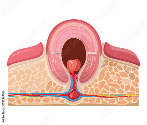 Cross-section illustration of a single tooth with a cyst or abscess forming at the root apex, showing the fluid-filled sac and surrounding inflamed tissue	