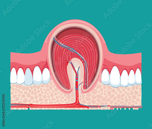 An illustration of a fractured tooth and root, showing the damage extending below the gumline and potentially causing periapical inflammation or infection	