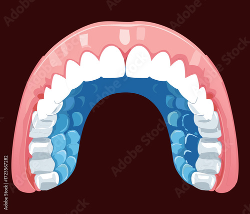 Dental Night Guard Mouthguard Appliance for Upper Teeth to Treat Bruxism and Protect Against Teeth Grinding	