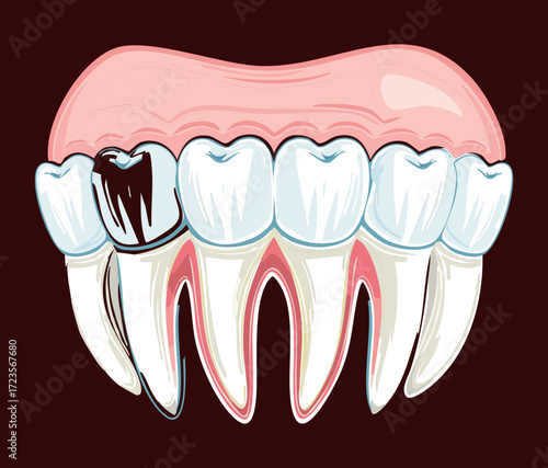 Cross-section of teeth with a dental filling and a crown, showing restorative treatment for a severe cavity or decay	