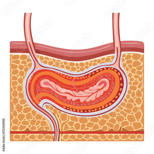 Inflamed Bowel Disease Concept Showing Cross-Section of Large Intestine Wall with Deep Ulceration	