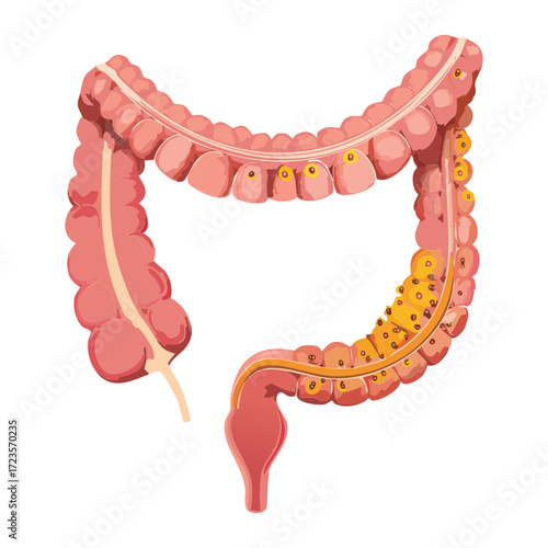 Irritable Bowel Syndrome or Colitis Concept Illustration Showing an Inflamed Large Intestine with Yellow Spots	