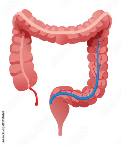 Close-up view of the distal colon and rectum highlighting deep inflammation and bloody ulcerations typical of severe chronic flare-ups in Ulcerative Colitis
