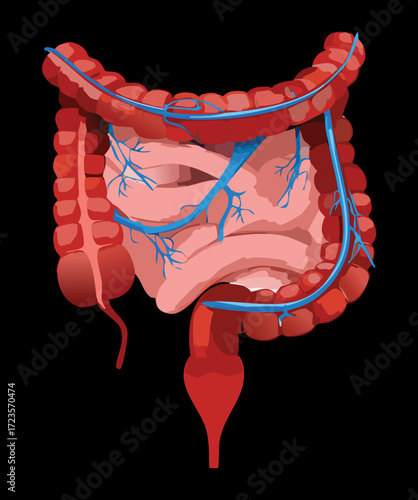 Conceptual visualization of an irritated and spastic large intestine within the human abdomen representing the chronic functional symptoms of Irritable Bowel Syndrome
