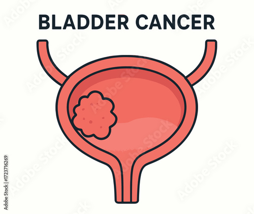 Medical illustration of bladder cancer with tumor cells inside the organ, showing anatomical detail. Ideal for healthcare, education, awareness campaigns, and medical publications.