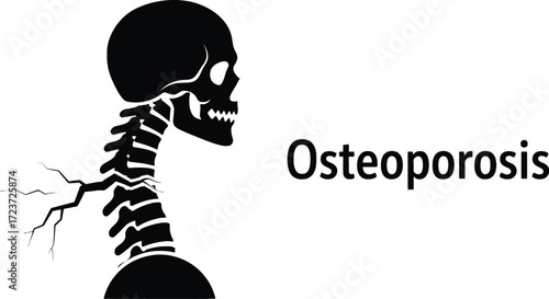 Osteoporosis illustration depicting a human skeleton with cracking bones and its effects on bone