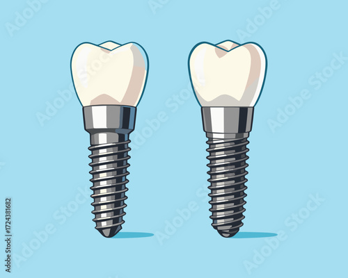 Dental Implants: A detailed, clean illustration of two meticulously rendered dental implants, showcasing the precision and innovation in modern dental care.