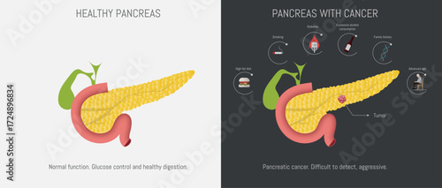 Healthy pancreas contrasting with pancreas with cancer