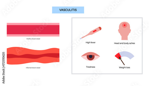 Vasculitis medical poster