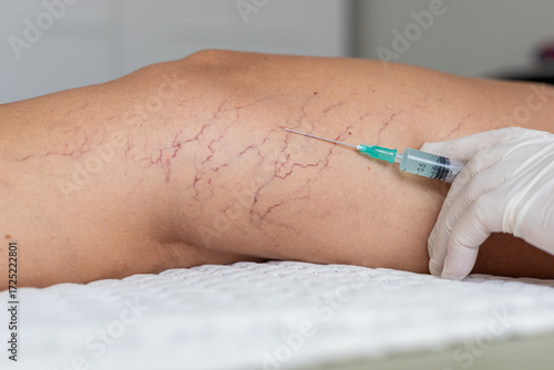 A close-up of a hand in a white glove administering an injection into a leg with visible varicose veins. The scene focuses on medical treatment for vein issues.