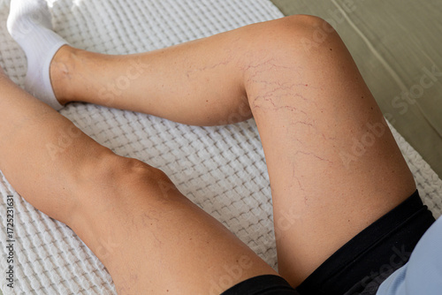 Foto Close-up of a person's legs showing visible veins and capillaries
