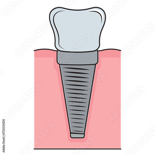 Dental implant. Screw prosthesis, Illustration of dental implantation,orthodontic dental implantation